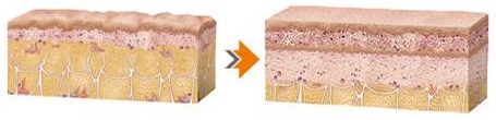 FatX Coreによるリモデリング効果